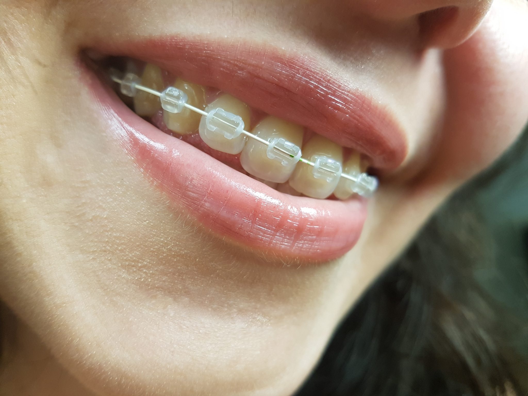 ¿Cómo saber cuándo te quitan los brackets? - Curiosidario